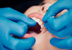 Dental Scaling 5 image2