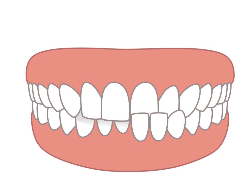 Crossbite