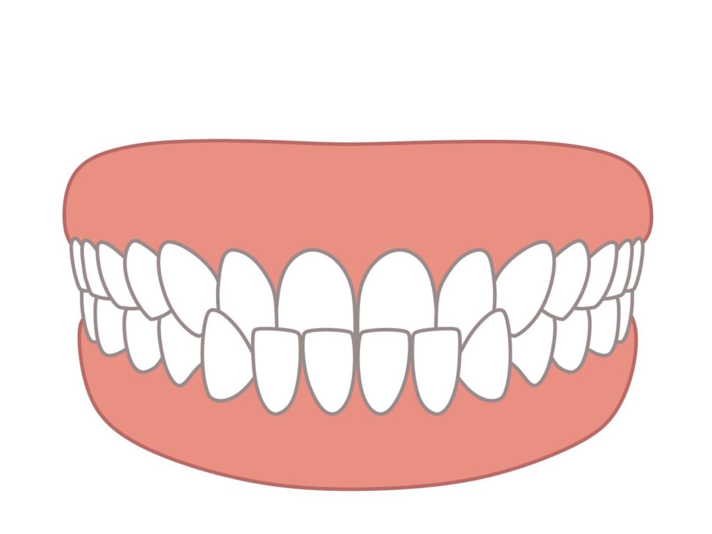 Underbite